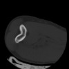 SPORK, NICO - 22.03.1976 - 02.08.2022 - CT obere Extremität - 17:59:38